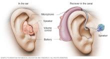 Hearing aid with common parts labeled