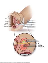 Needle delivering radioactive source into the prostate