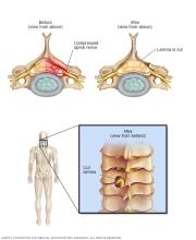 Illustration of laminotomy