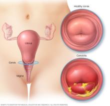 Healthy cervix and cervix with cervicitis