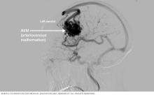 Brain AVM angiogram