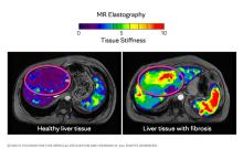 Magnetic resonance elastography images showing a healthy liver and a liver with fibrosis.