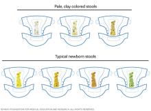 The color of typical newborn stools and pale stools seen in biliary atresia