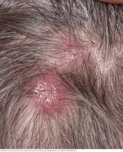 Cutaneous B-cell lymphoma on the scalp