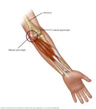 Illustration of golfer's elbow
