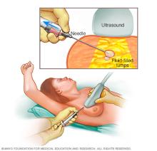 Illustration of a fine-needle aspiration of the breast