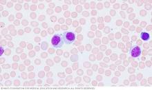 Hairy cell leukemia cells under a microscope