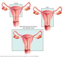 Illustration showing types of hysterectomy