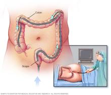 Illustration showing colonoscopy