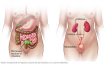 Part of small intestine used for neobladder reconstruction