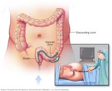 Illustration of flexible sigmoidoscopy