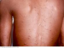 Chickenpox on brown skin