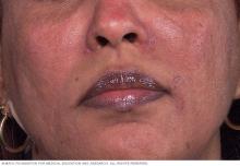 Rosacea on brown or Black skin can cause patches of brown discoloration.