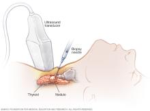 Needle biopsy of thyroid cancer 