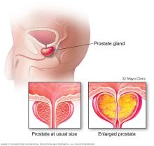Enlarged prostate compared with prostate at usual size
