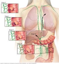 Colon cancer stages 