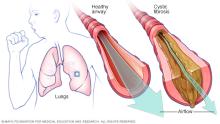 Normal airway versus airway with cystic fibrosis
