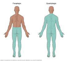 The area of the body affected by paraplegia and quadriplegia