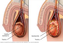 Scrotum, testicle and epididymis