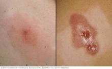 On white skin a red pimple surrounded by pink skin and a raised, crusty, dark red blotch with broken skin.