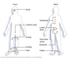 Illustration showing common inflammation sites in reactive arthritis