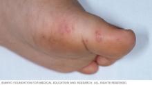 Photo of rash on the foot caused by hand-foot-and-mouth disease 