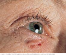 Basal cell carcinoma on white skin
