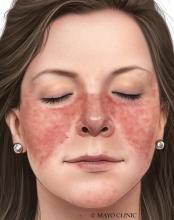 Butterfly-shaped rash on nose and cheeks