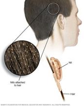 Illustration showing nits on hair