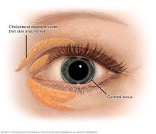 Cholesterol deposits around the eye and corneal arcus