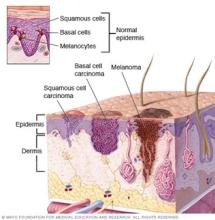 Where skin cancer develops