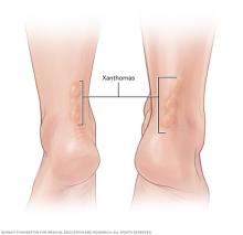 Cholesterol deposits on the Achilles tendon called xanthomas