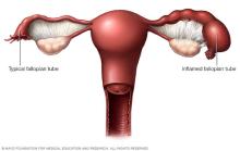 Illustration of pelvic inflammatory disease inflamed fallopian tube 