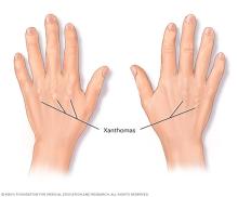 Cholesterol deposits on the hands called xanthomas