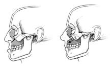 In upper jaw surgery, the surgeon makes cuts in the upper jaw, moves it forward, backward, up or down as needed and secures it with plates and screws. 
