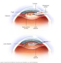 Two of the steps in cataract surgery