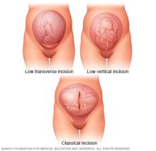 Uterine incisions used during C-section