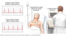 Person undergoing cardioversion 