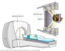 Gamma Knife stereotactic radiosurgery