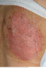 A TEN rash on a woman's back causes loose, peeling skin.