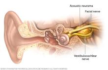 Acoustic neuroma and facial and vestibulocochlear nerves