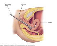 Illustration showing what happens during a sonohysterography procedure