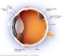 Where eye melanoma occurs