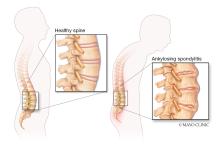 Spinal changes in ankylosing spondylitis