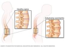 Illustration of spinal changes in ankylosing spondylitis.