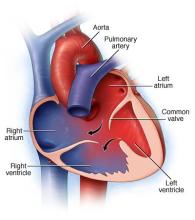 Illustration showing atrioventricular canal defect 
