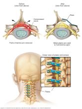 Illustration of laminoplasty
