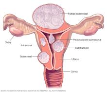 Illustration showing fibroid locations