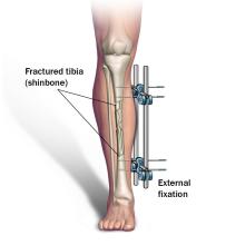 External fixation of the shinbone.
