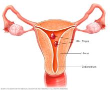 Illustration of uterine polyps